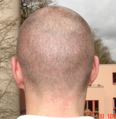 Haarkranz 4 Wochen nach der FUE Haartransplantation rasiert auf 1 mm