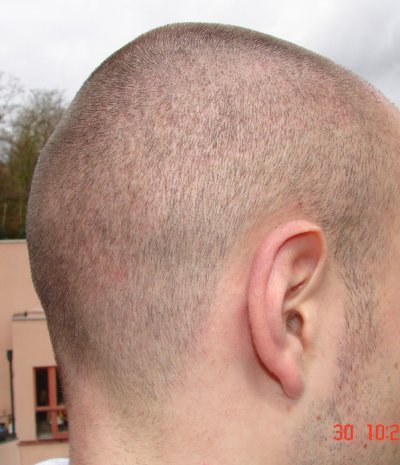 Haarkranz 4 Wochen nach der FUE Haartransplantation von rechts hinten rasiert auf 1 mm