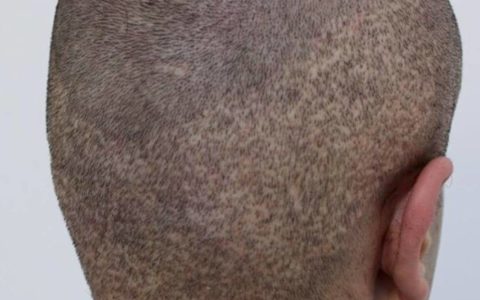 Ausgedünnter Haarkranz nach einer verpfuschten FUE Haarverpflanzung in der Türkei: Vorher mit Rasur