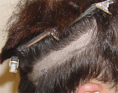 Streifen-Haartransplantation