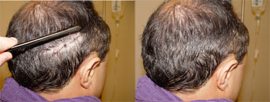 Links direkt nach der Streifen-Haarverpflanzung und rechts die Wunde verdeckt durch die längeren Deckhaare