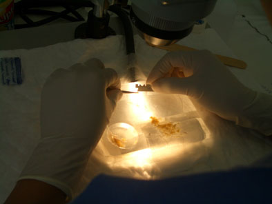 FUT Haartransplantation und die Zergliederung des Hautstreifens in einzelne follikuläre Einheiten/Grafts