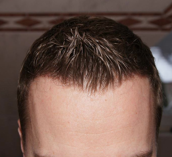 Haartransplantation Dense Packing bei Männern