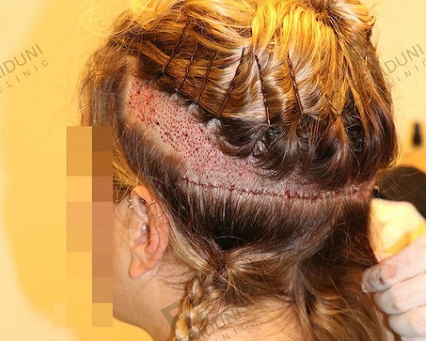 Frauen FUE Haartransplantation mit Teil/Streifen-Rasur im Donor