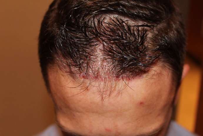 Unaufällige und unbemerkte Haartransplantation ohne Rasur der Empfangszone - Erhöhung der Haardichte