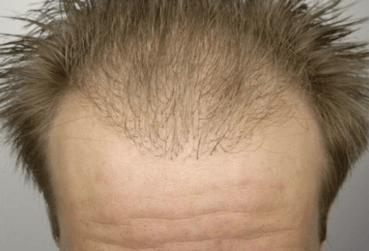 Fall Marco nach der Haartransplantation in Deutschland und vor dem Korrektur-Eingriff von vorne nah