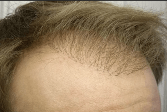 Fall Marco nach der schlechten Haartransplantation in Deutschland und vor dem Korrektur-Eingriff von vorne nah