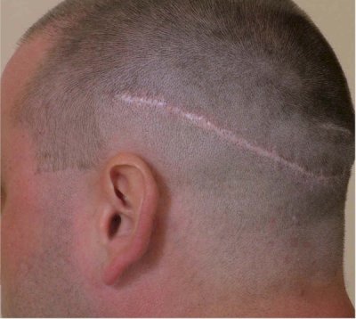 Beispiel einer FUT Haartransplantation Narbe im rasierten Zustand