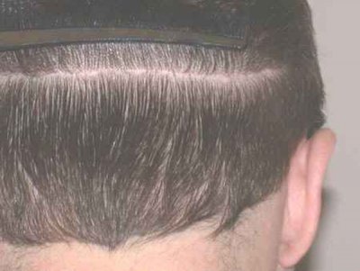 FUT Haartransplantation und die präparierten Grafts/Follicular Units