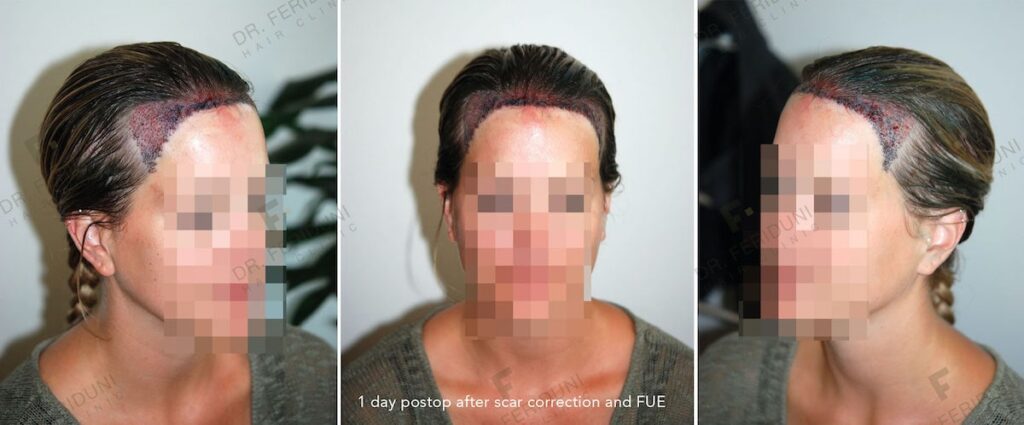 Beispiel einer Frauen Haarverpflanzung der Ecken und hohen Stirn ohne jegliches rasieren der Empfangszone