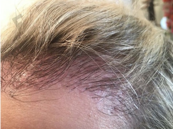 Weiblicher Patient nach misslungener Haartransplantation: Unzureichende Dichte, vereinzelt dicke Grafts in der Front