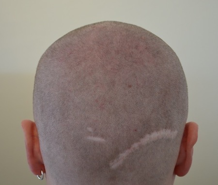 Hinterkopf der missglückten Haarverpflanzung: Deutlich zu erkennende Narben