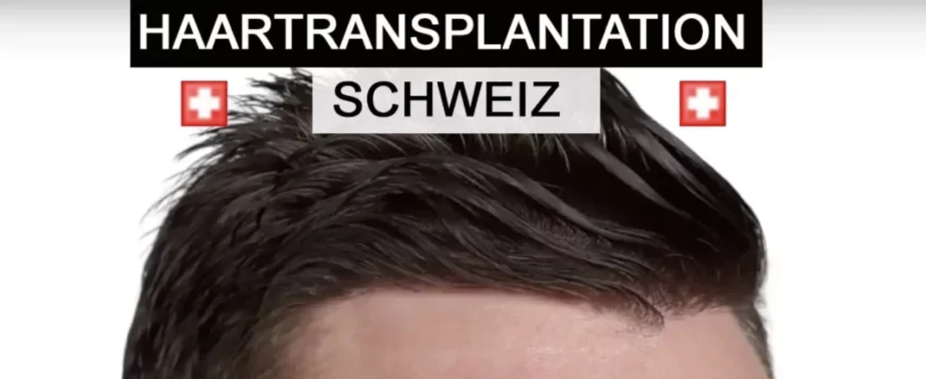 Haartransplantation Schweiz Ärzte und Kliniken
