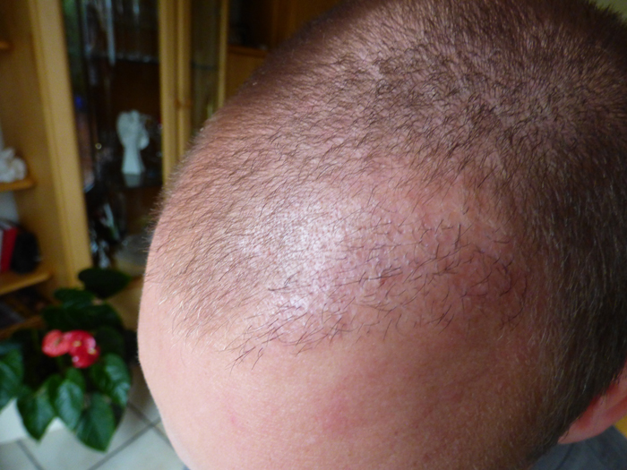 Misslunge Haartransplantation Marcel-k-empfangsgebiet-l