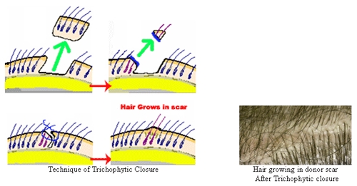 FUT Haartransplantation mit Tricophytic Closure Technik