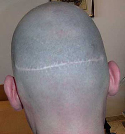 Haartransplantation Narbe am Hinterkopf Beispiel 1