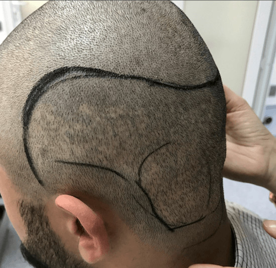 Haartransplantation Narbe entfernen - Entfernung