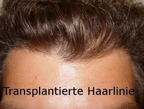 Haartransplantation: Transplantierte Haarlinie