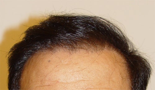 Natürliche Haarlinie nach Haartransplantation nah