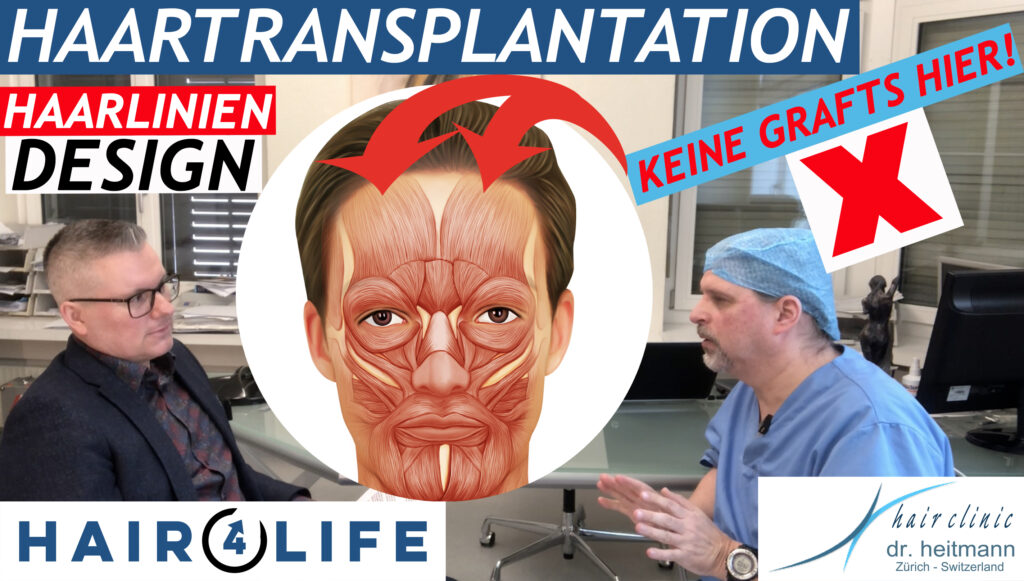 Haartransplantation Haarliniendesign natürliche vs. künstliche Haarlinie Thema künstlicher Haaransatz bei Transplantation in die mimische Muskulatur Natürliche oder künstliche Haarlinie - Dr. Lars Heitmann