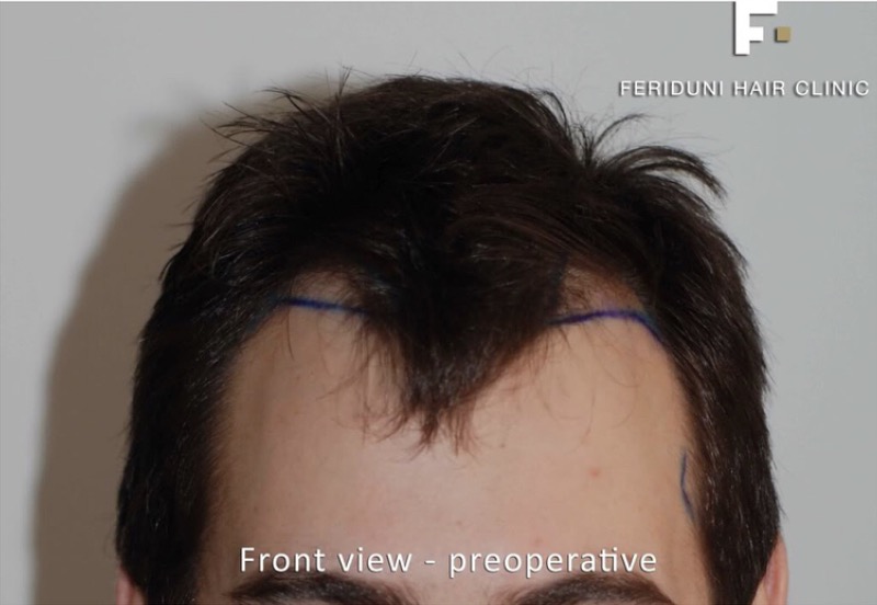 Haartransplantation bei Geheimratsecken 