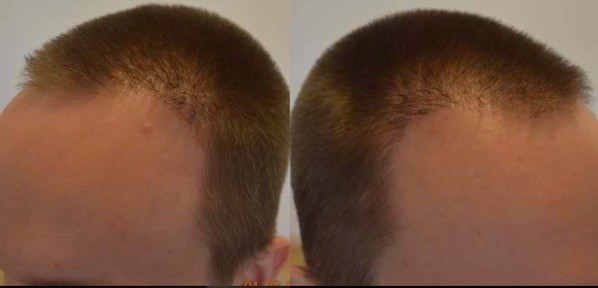 Risiken Haartransplantation Geheimratsecken Beispiel falsche Wuchsrichtung