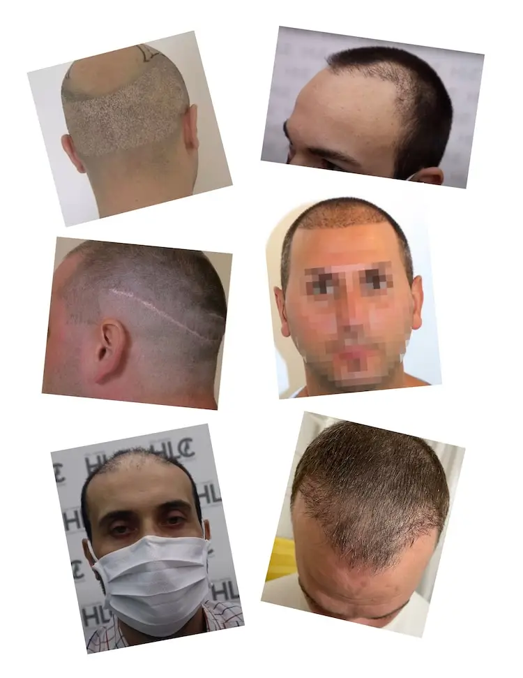 Haartransplantation gescheitere Beispiele