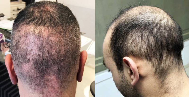 Herausforderung von Haartransplantation Korrekturen: Wenig Spenderhaare Herausforderung von Haartransplantation Korrekturen: Wenig Spenderhaare