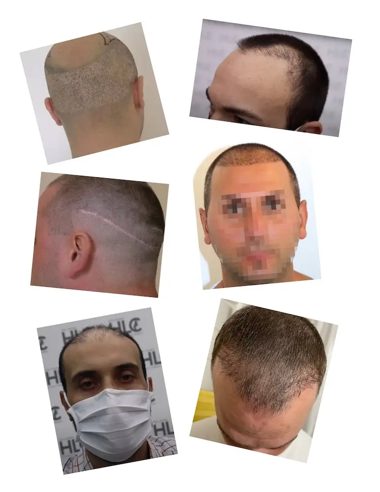 Notwendigkeit einer Haartransplantation Korrektur - Beispiele gescheiterte OPs