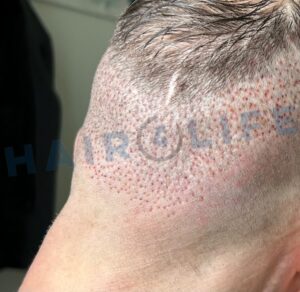 1. Haartransplantation FUE Donor Shockloss-OP 03., 04. und 05. April 2025