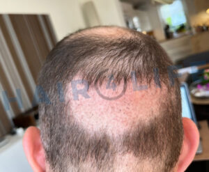 3. Haartransplantation FUE Donor Shockloss-Anfang Mai 2024 - ausgeprägter Shockloss