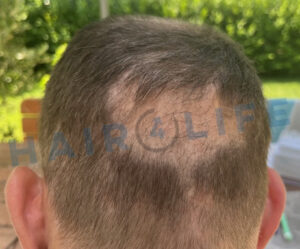 5. Haartransplantation FUE Donor Shockloss Mitte Juni 2024