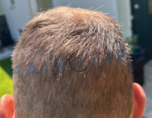 6. Haartransplantation FUE Donor Shockloss Ende Juli 2024