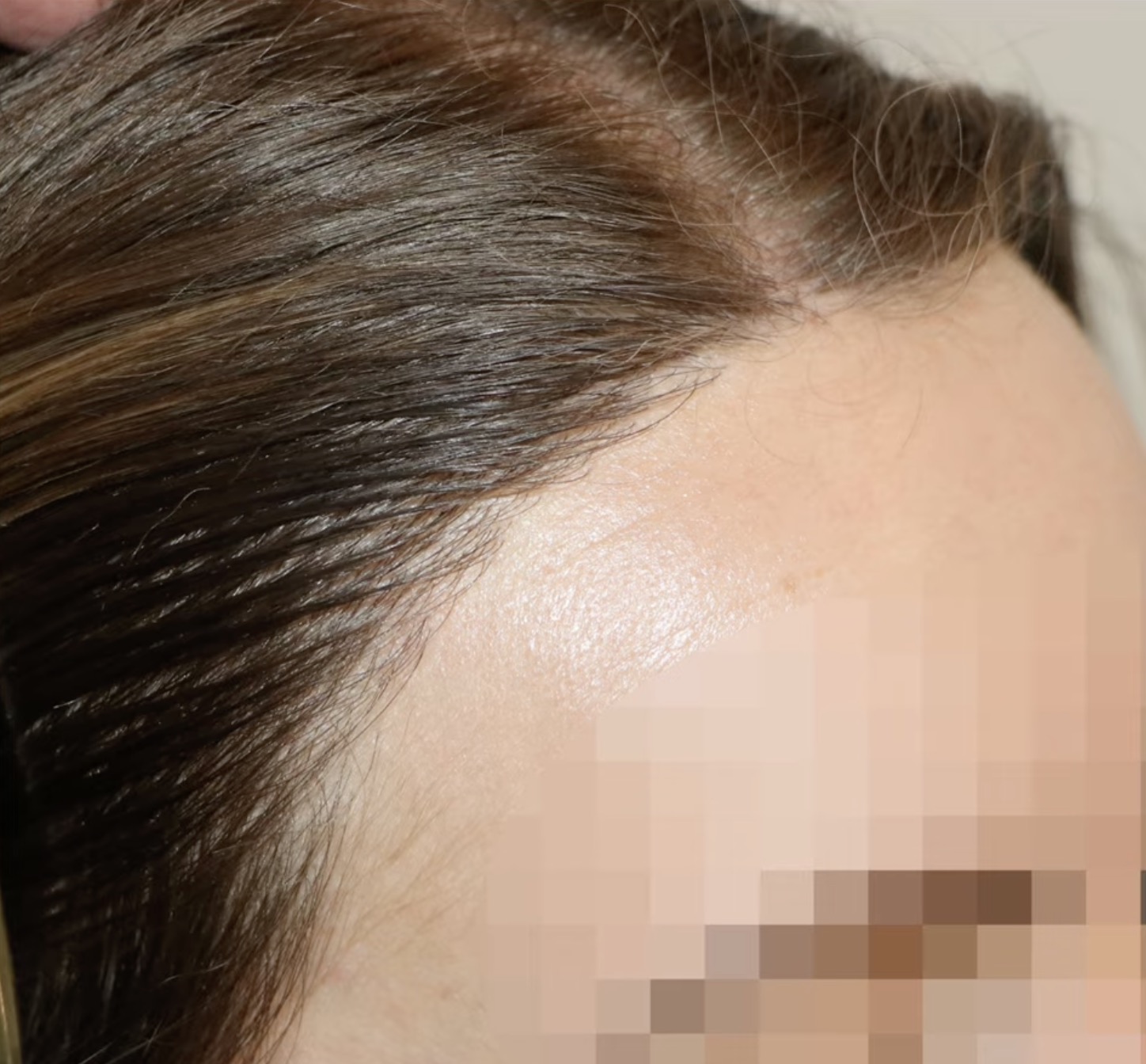 Harmonische weibliche Haarlinie nach Haartransplantation