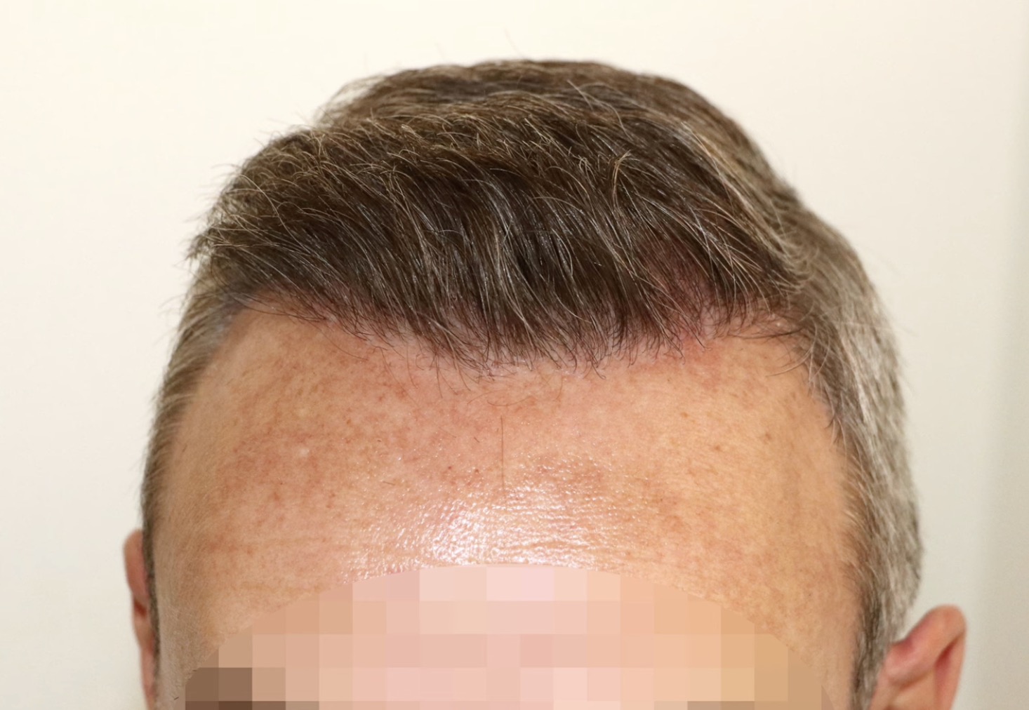 Natürlich wirkendes Ergebnis nach Haartransplantation mit harmonischer Haarlinie