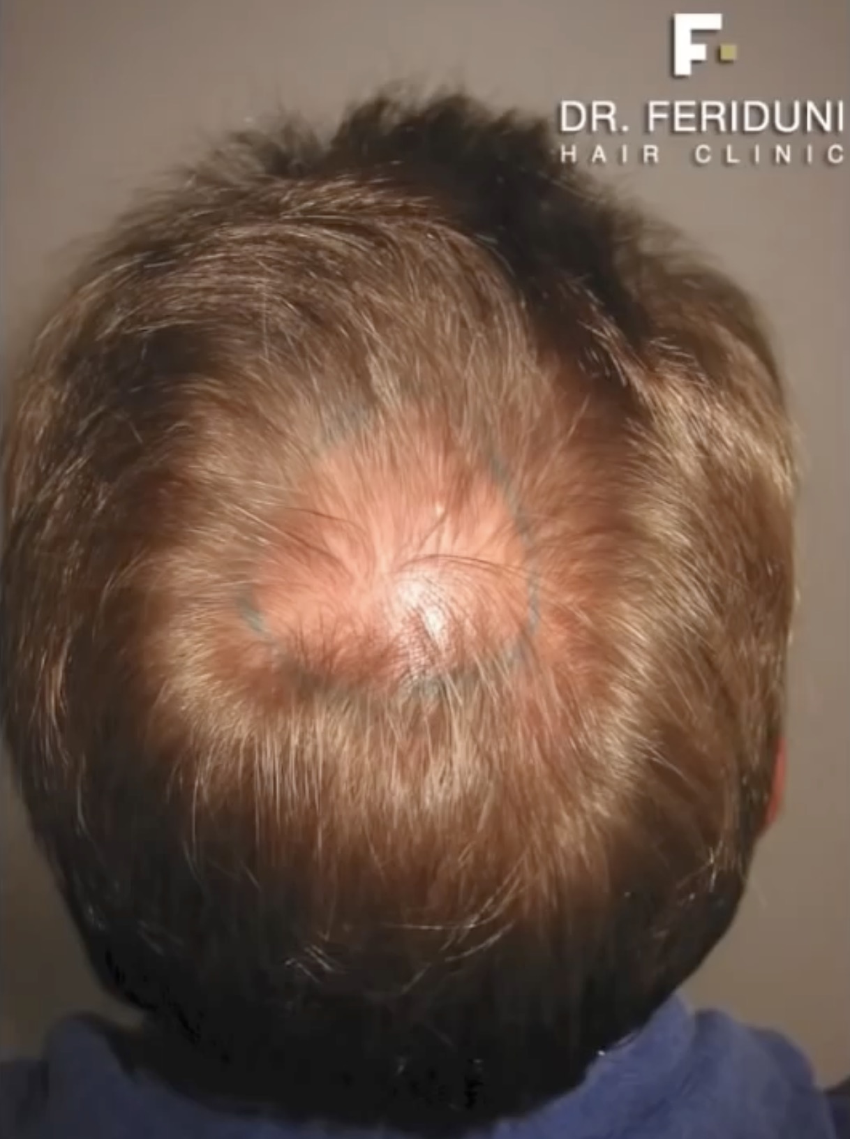 Beginnender erblich bedingter Haarausfall in der Tonsur Mönchsglatze