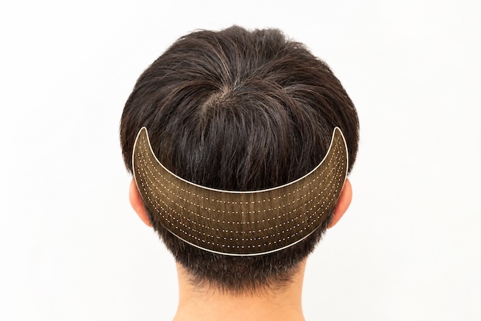 Tonsur und Spenderbereich bei der Planung einer Haartransplantation