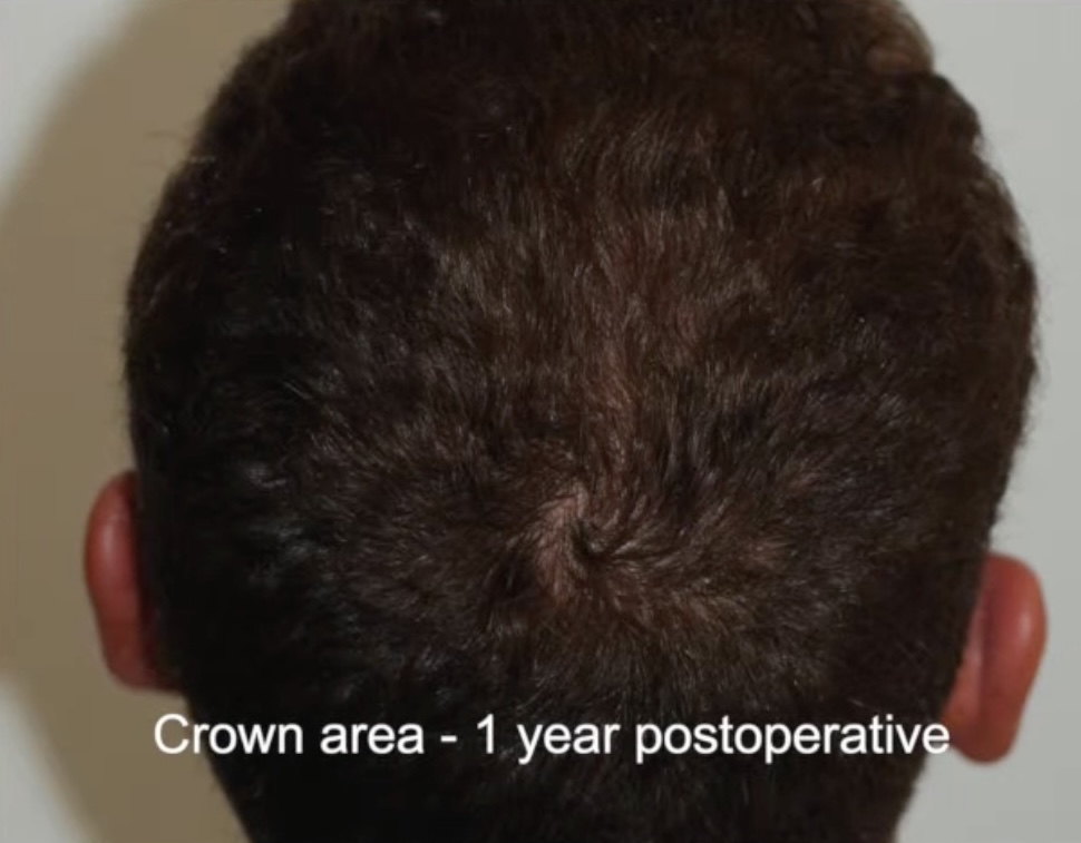 Resultat einer Haartransplantation der Tonsur mit 1408 FUs
