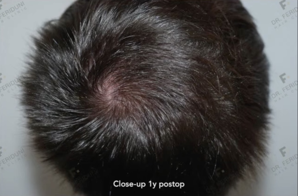 Resultat einer Haartransplantation der Tonsur mit 1486 FUs