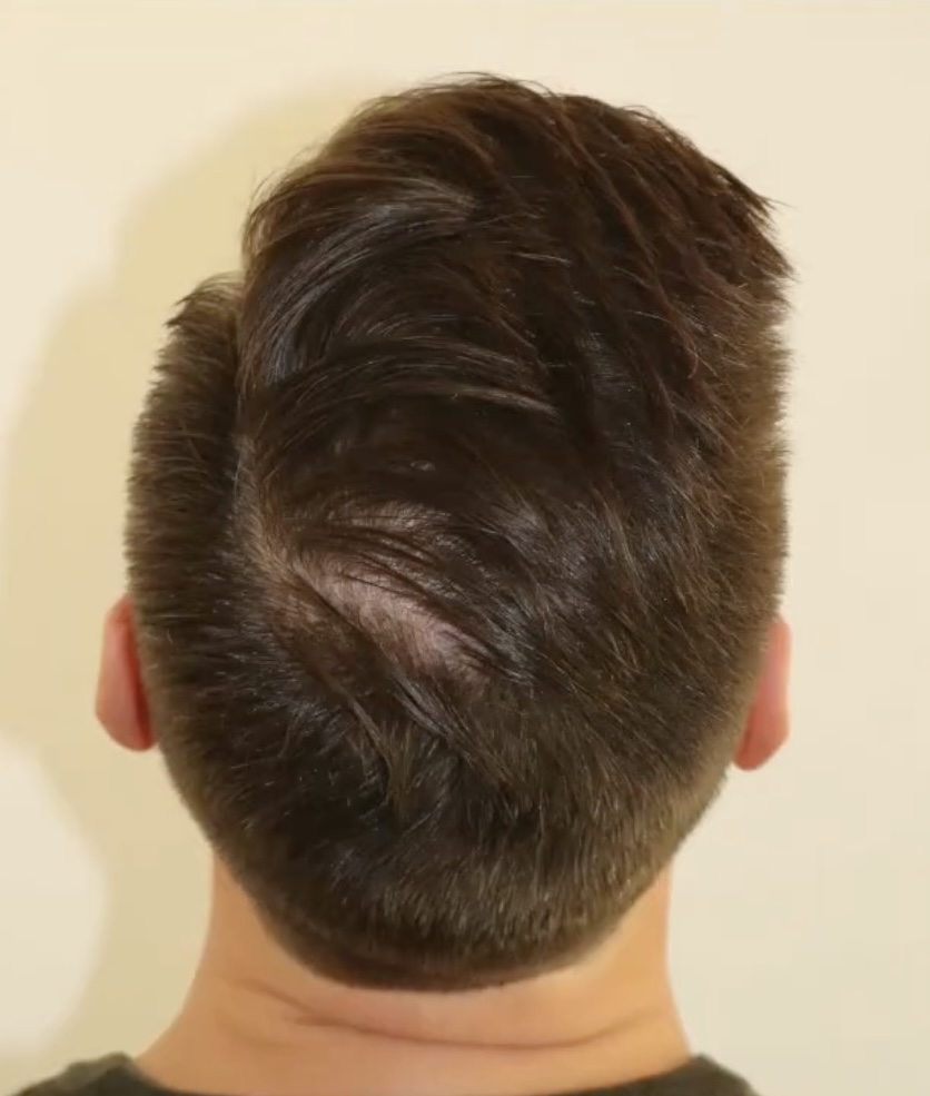 Resultat einer Haartransplantation der Tonsur mit 1906 FUs