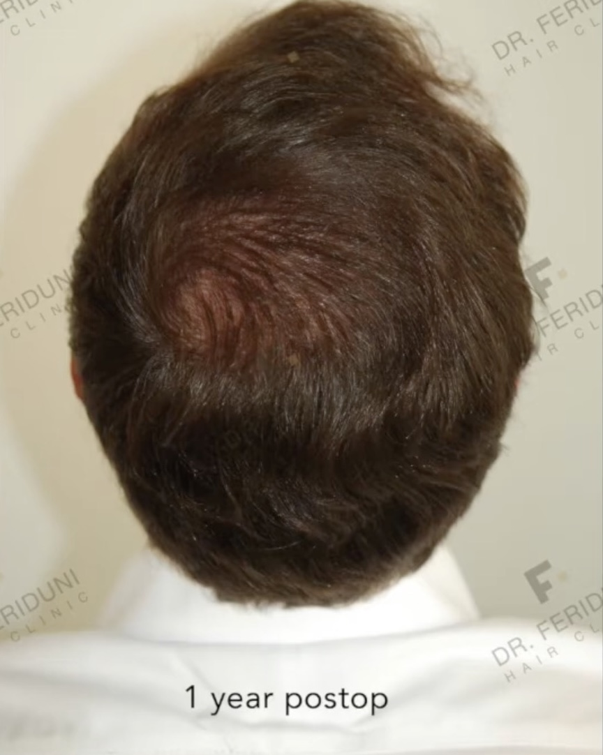 Resultat einer Haartransplantation der Tonsur mit 2760 FUs