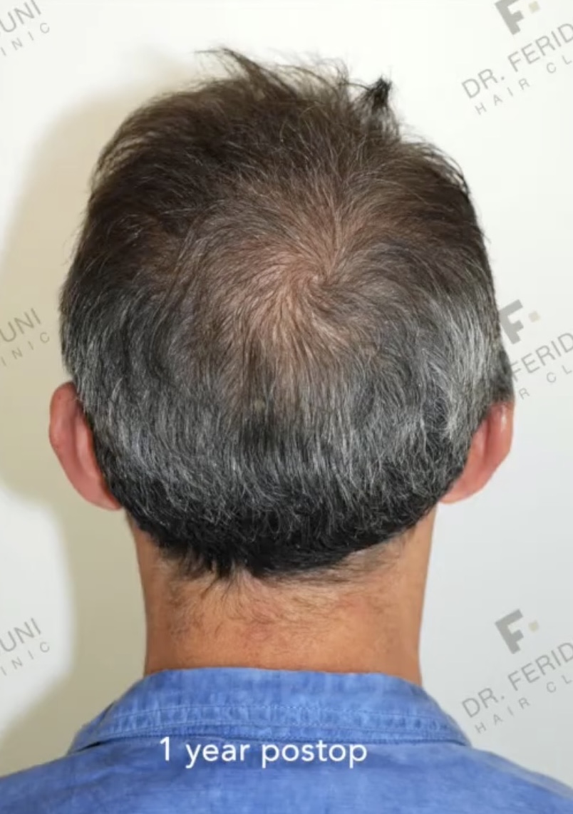 Resultat einer Haartransplantation der Tonsur mit 763 FUs