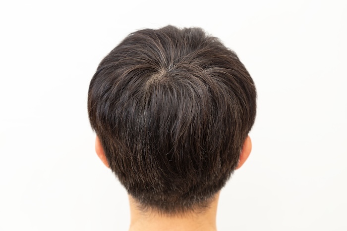 Natürlicher Haarwirbel und sichtbare Kopfhaut in der Tonsur