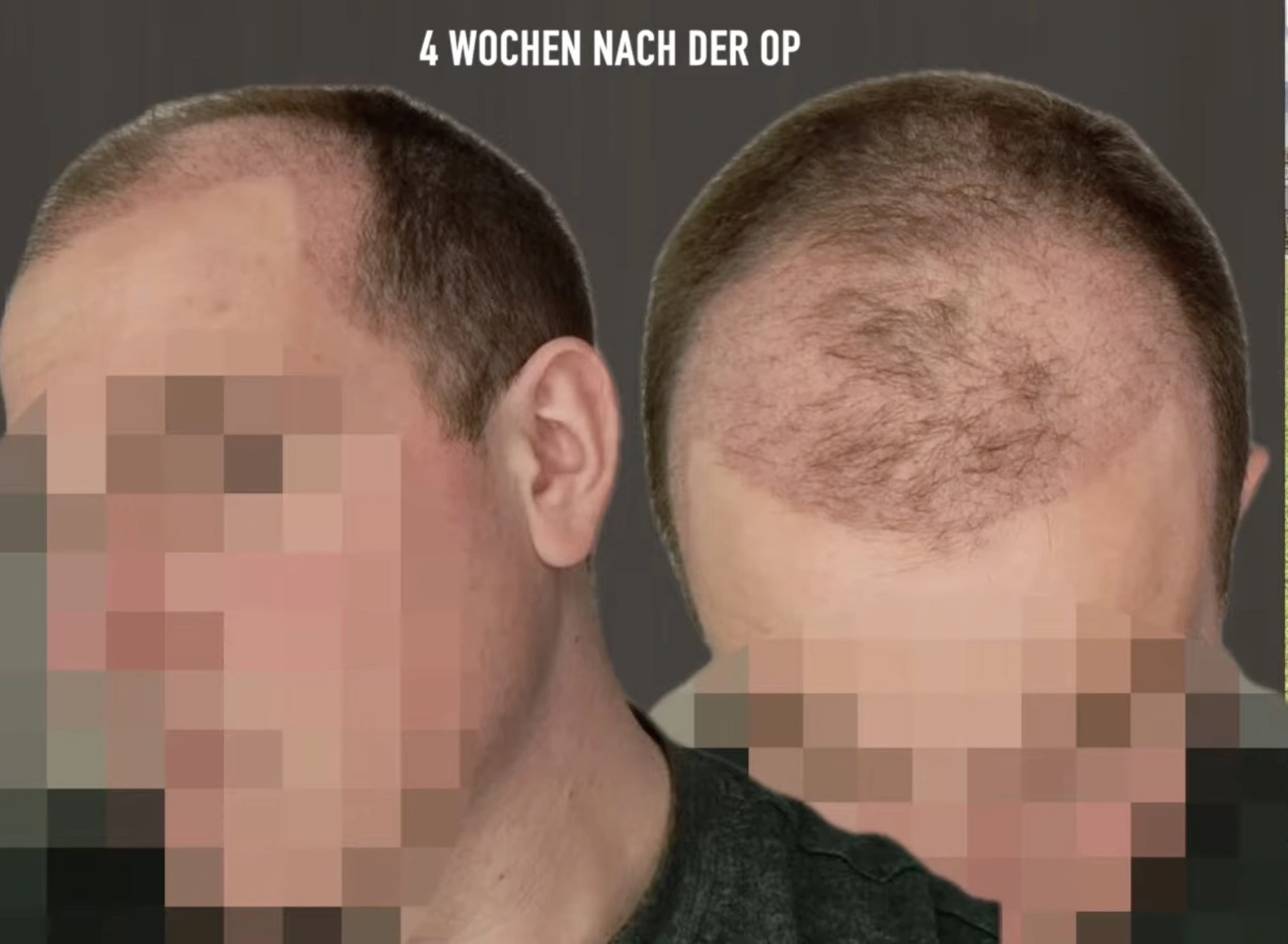 Noch sichtbare Rötung der Kopfhaut vier Wochen nach einer Haartransplantation