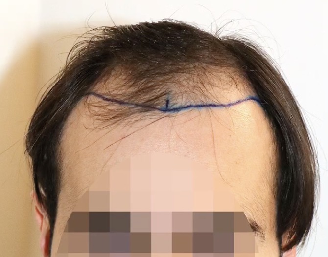 Fortschreitender genetischer Haarausfall am Oberkopf