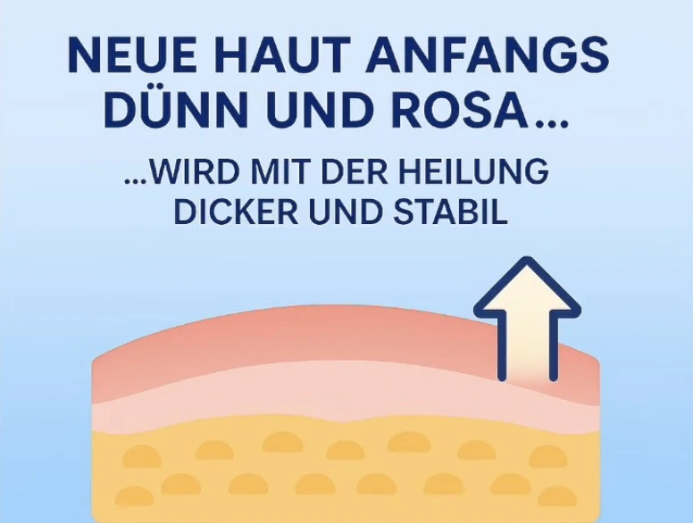 Grafik zur Hautheilung: Frisch regenerierte Haut ist zunächst dünner und rosa und wird während der Heilung dicker