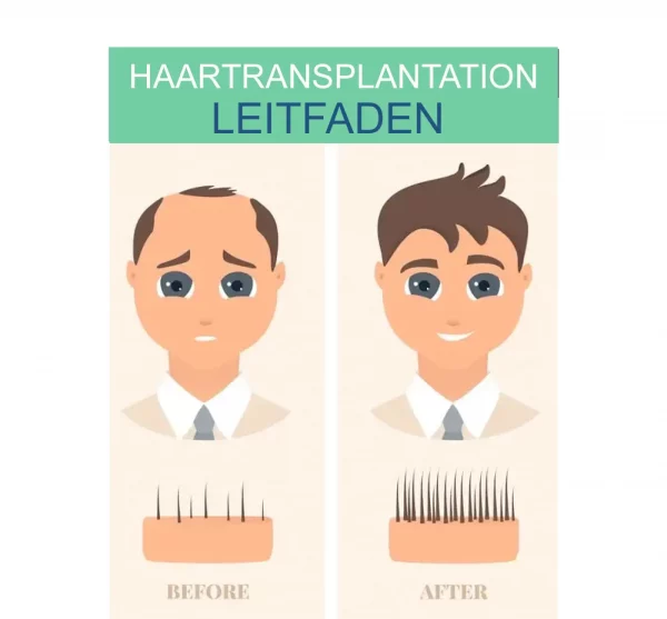 Haartransplantation Leitfaden Fakten und Ablauf